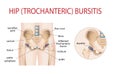 hip pain bursitis, arthritis.of painful hip sacral inflammation. Royalty Free Stock Photo